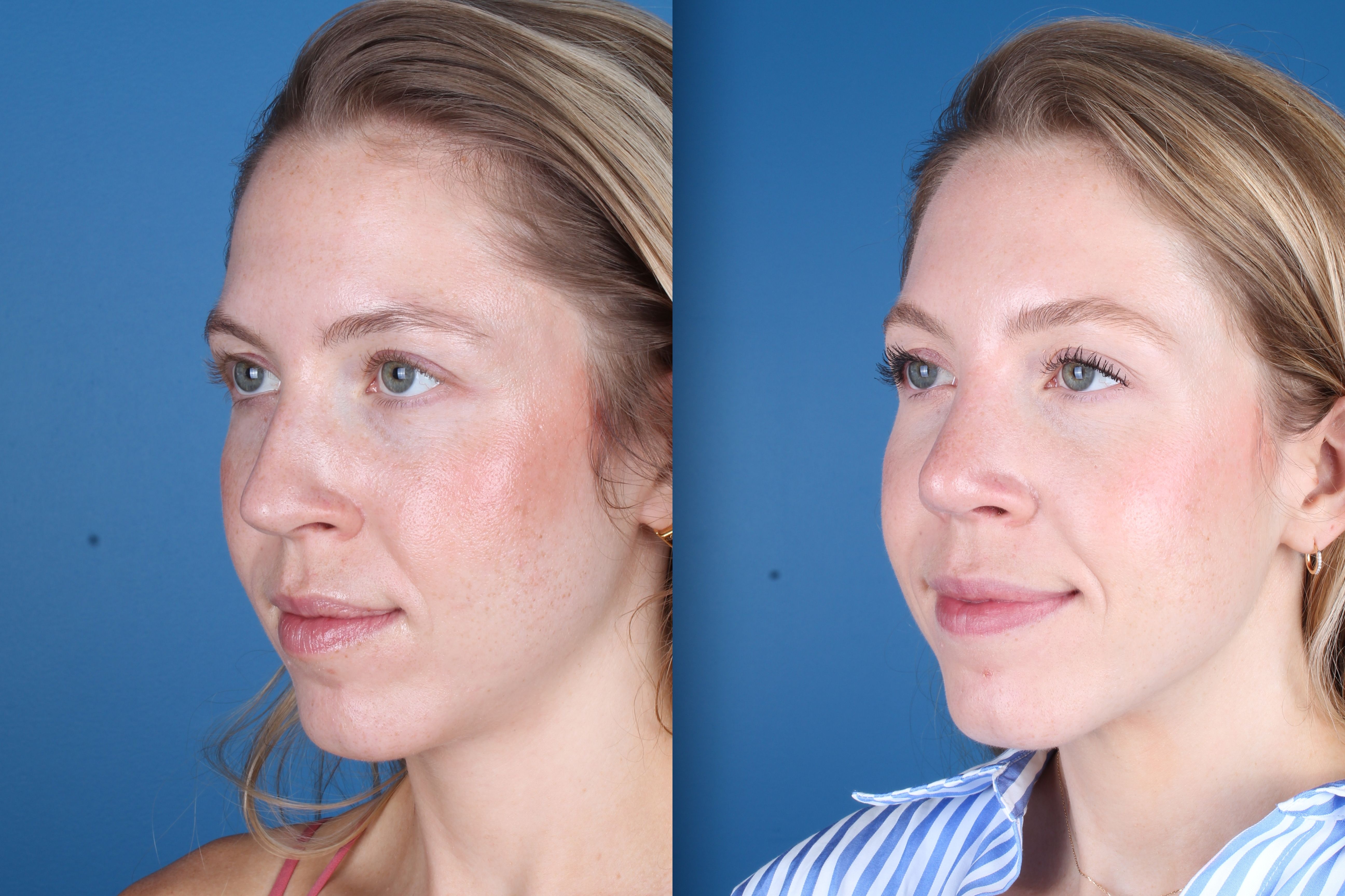 Denver Rhinoplasty Before And Afters Raval Facial Aesthetics